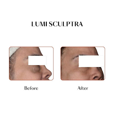 Firmer skin with Sculptra collagen treatment at Luminisce