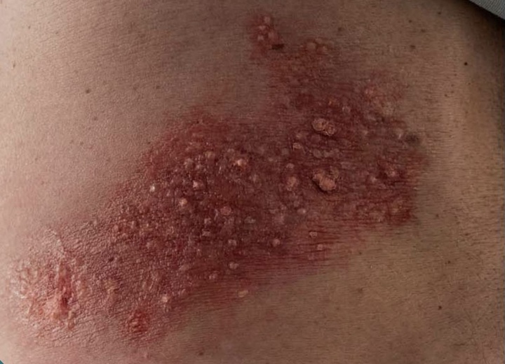 Shingles Rash